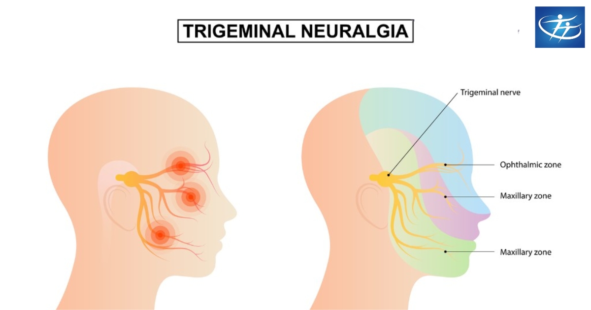 Advanced Treatment Options for Trigeminal Neuralgia in Indore